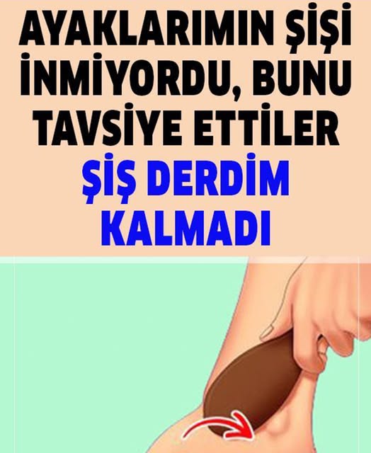 Şişmiş Ayaklar İçin Ne Yapılmalı? - 1