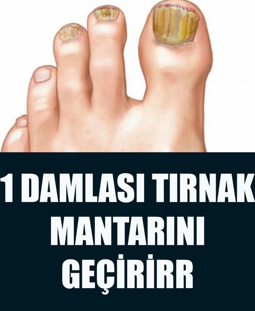 Basit Bir Yöntemle Tırnak Mantarından Kurtulun - 2