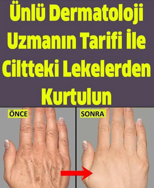 Ünlü Dermatoloji Uzmanın Tarifi İle Ciltteki Lekelerden Kurtulun - 2