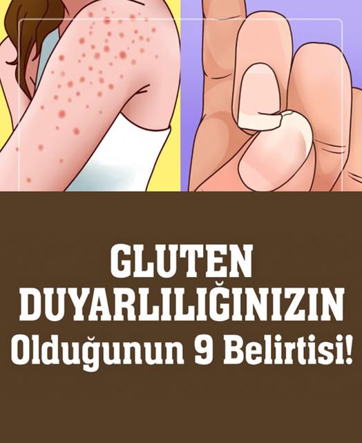Gluten Hassasiyetinin 9 Belirtisi ve Tedavisi - 1
