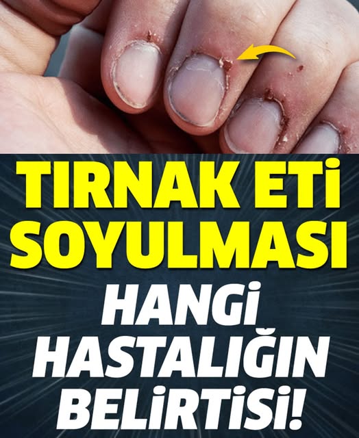 Tırnak Soyulması Hangi Hastalığın Belirtisi - 2