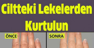 Ünlü Dermatoloji Uzmanın Tarifi İle Ciltteki Lekelerden Kurtulun	