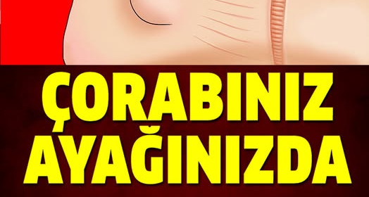 Çorabınız Ayağınızda İz Bırakıyorsa Dikkat	